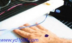 能促進傷口愈合的&ldquo;打印機&rdquo;